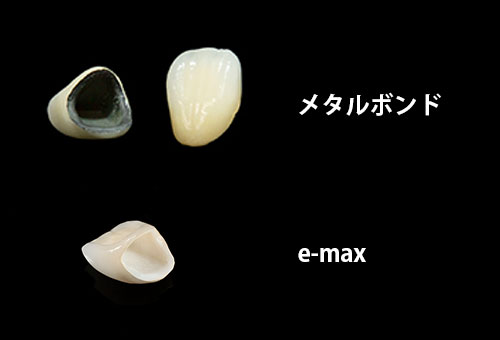 自費の詰め物・被せ物について